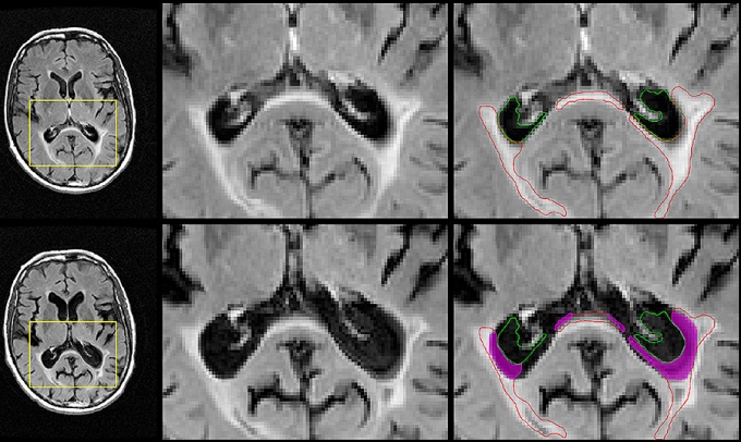A better MRI marker for disability progression in MS Image